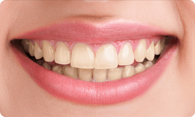 Before (Teeth)