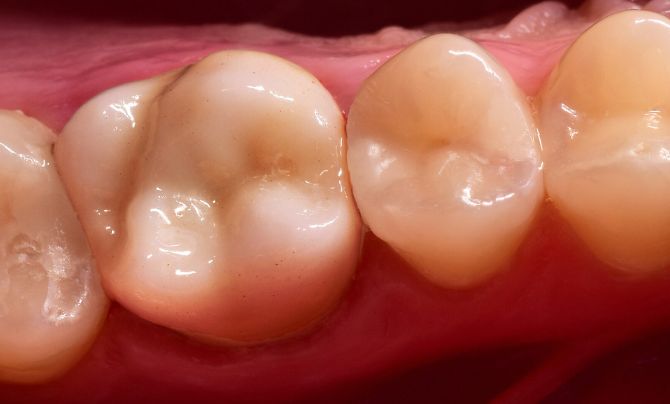 After (Teeth)