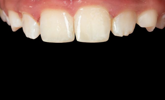 After (Teeth)