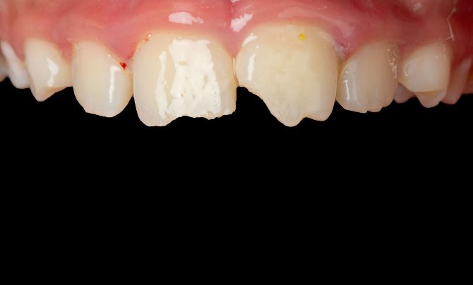 Before (Teeth)