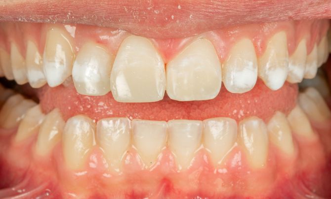 After (Teeth)