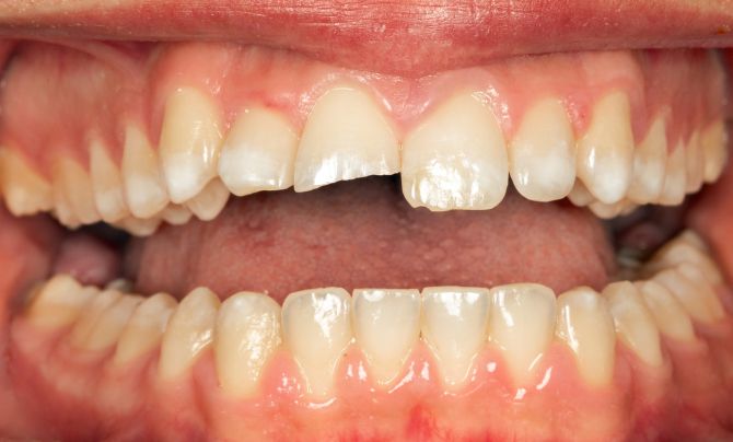 Before (Teeth)