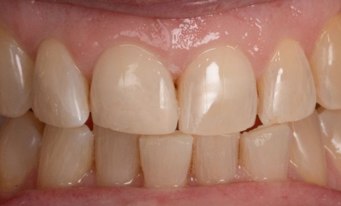 After (Teeth)