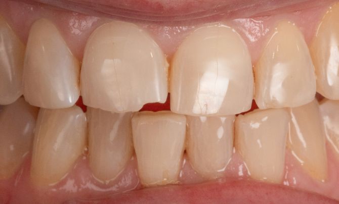 Before (Teeth)